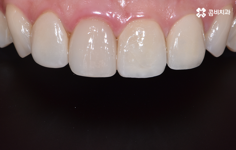 앞니 충치치료 개인에 따라 달라지는 이유 관련 이미지 11