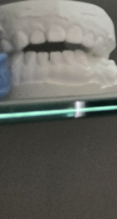 완전매복사랑니 발치 대학병원 꼭 가야하나요 관련 이미지 29