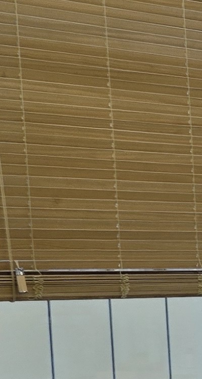 임플란트 뼈이식 안하면 어떤 문제가 있는거죠 관련 이미지 24