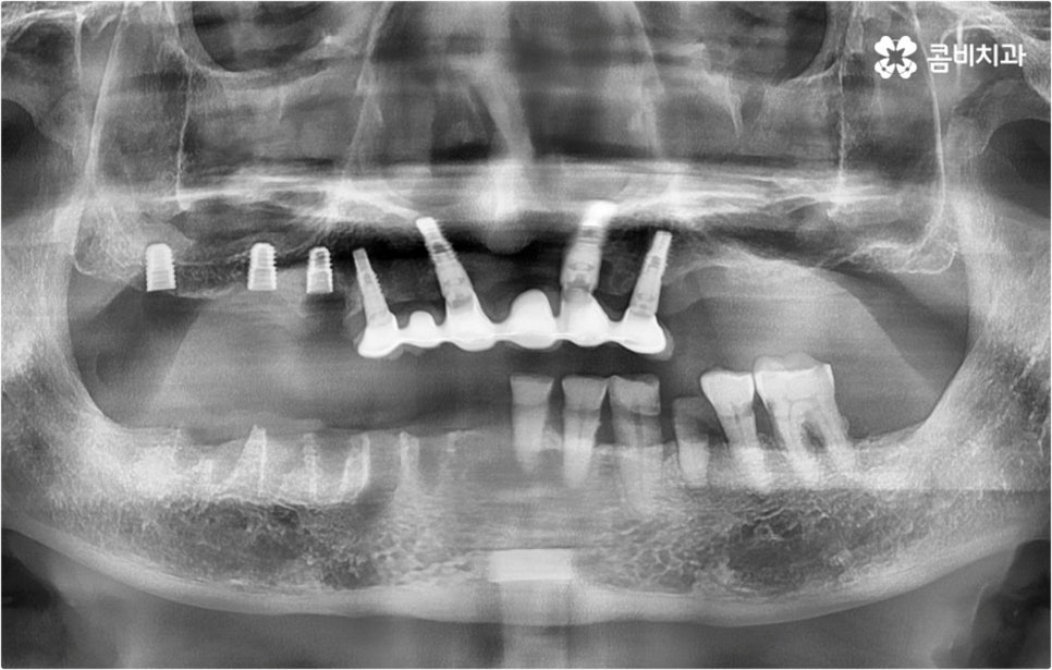 전악임플란트 고려할 사항들은 관련 이미지 9