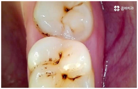 임플란트 종류 어떤게 맞을까요? 관련 이미지 12