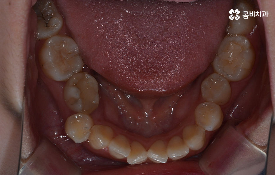 덧니 발치 교정 이런 경우에는 필요합니다 관련 이미지 6