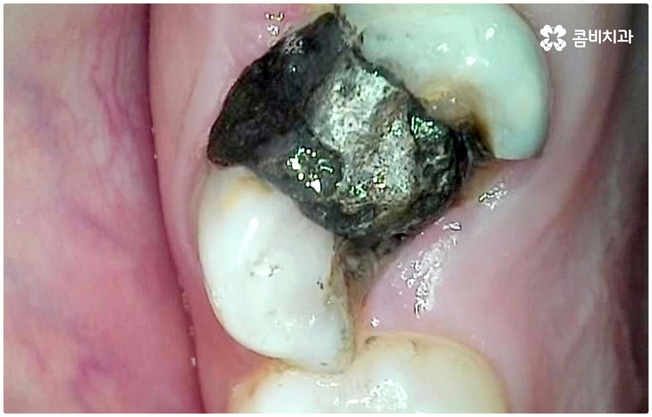 명동치과 평소에 케어하기 관련 이미지 3