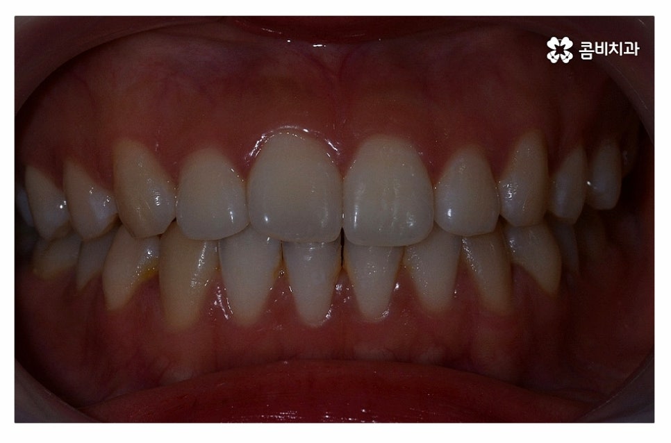 돌출입치아교정 적극적으로 해결하려면 관련 이미지 2