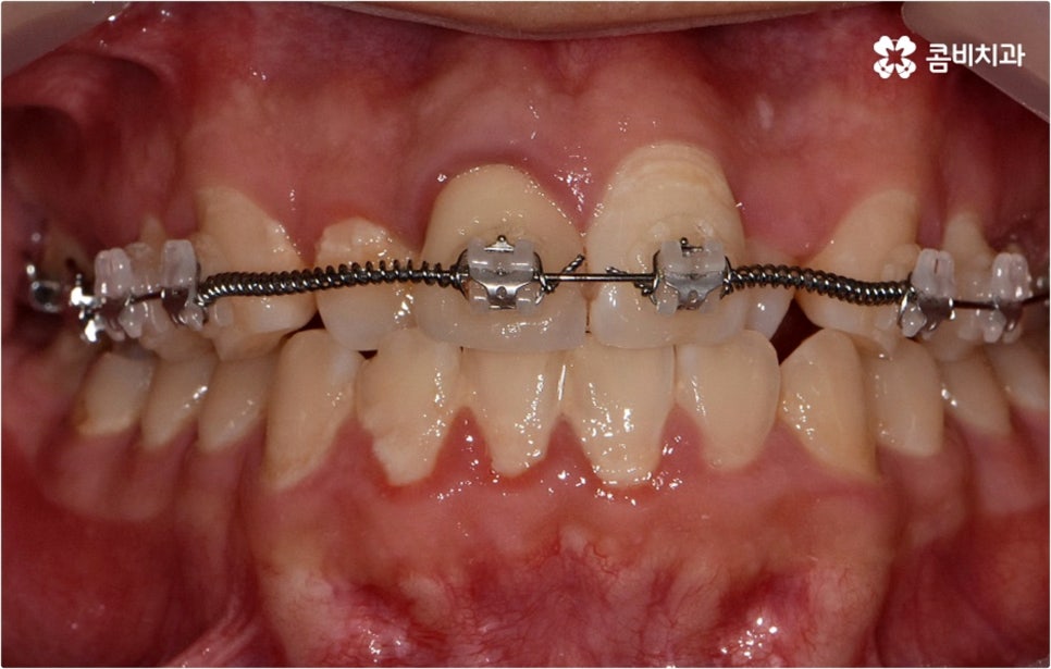 덧니교정 하고싶다면 관련 이미지 8