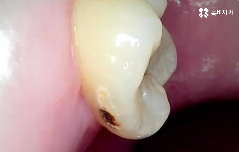 충치 신경치료 안하면 후회하는 이유 관련 이미지 2
