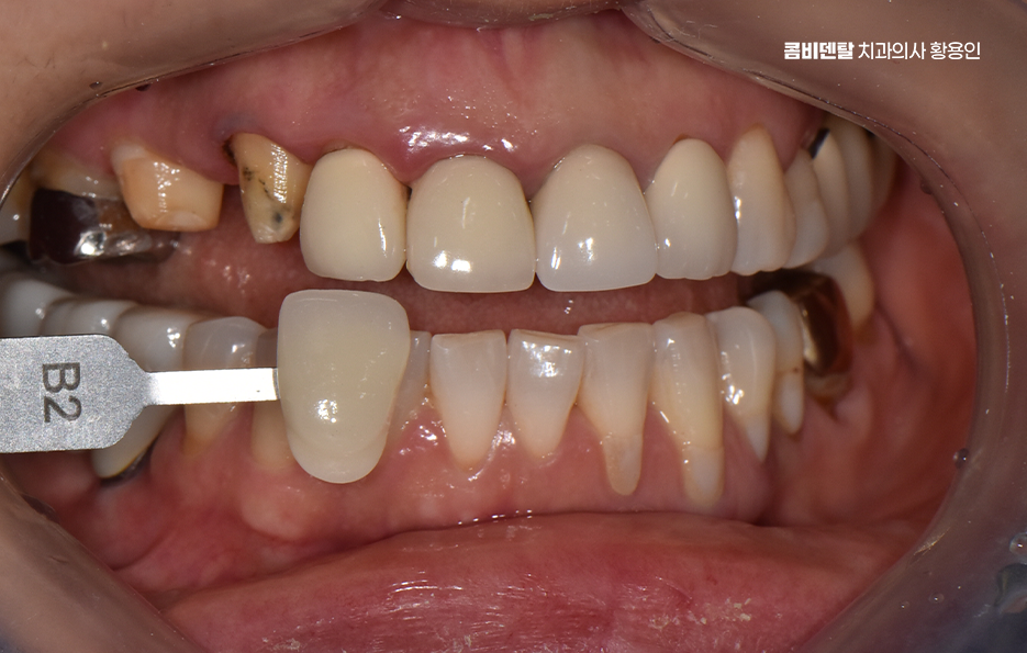 앞니 크라운 교체 깔끔하게 정리하려면 관련 이미지 5