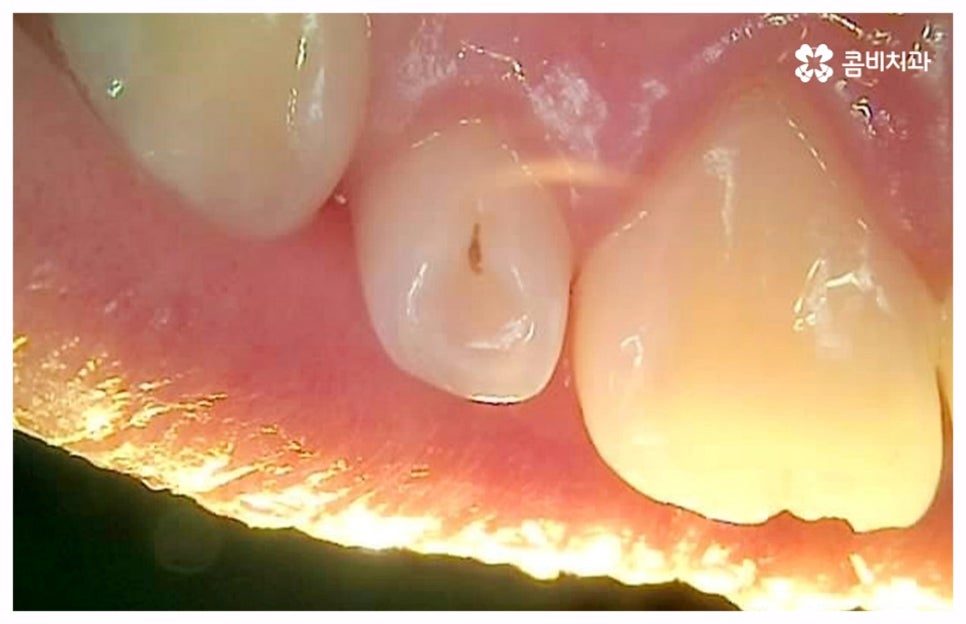 치통이 심할때 어떻게 해야하나요 관련 이미지 2