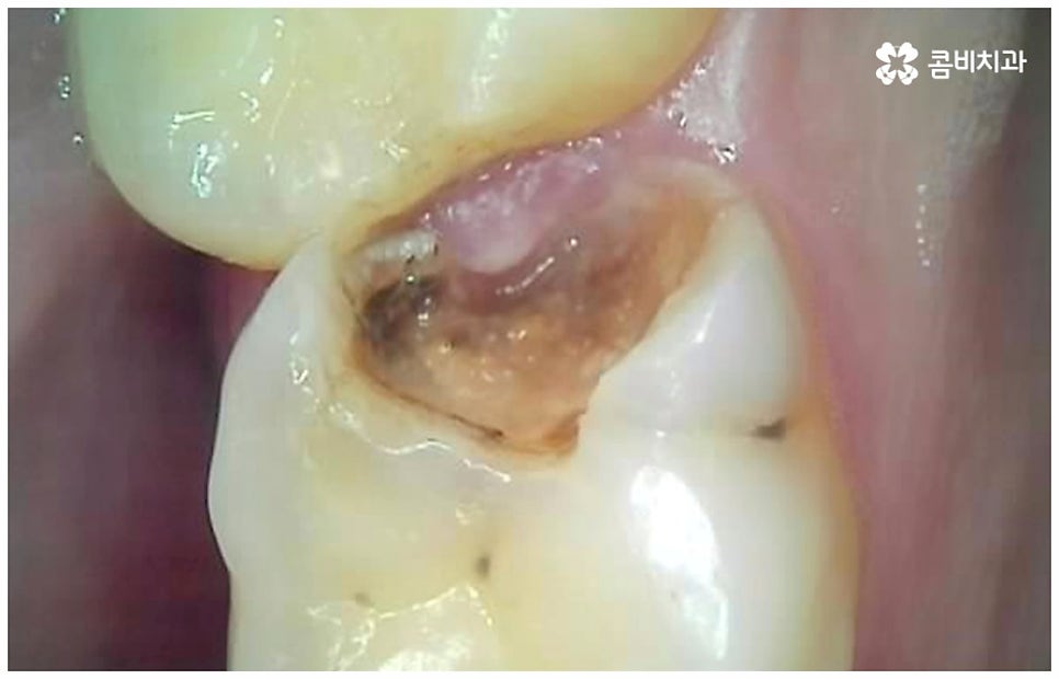 어금니신경치료 케이스마다 달라요 관련 이미지 4