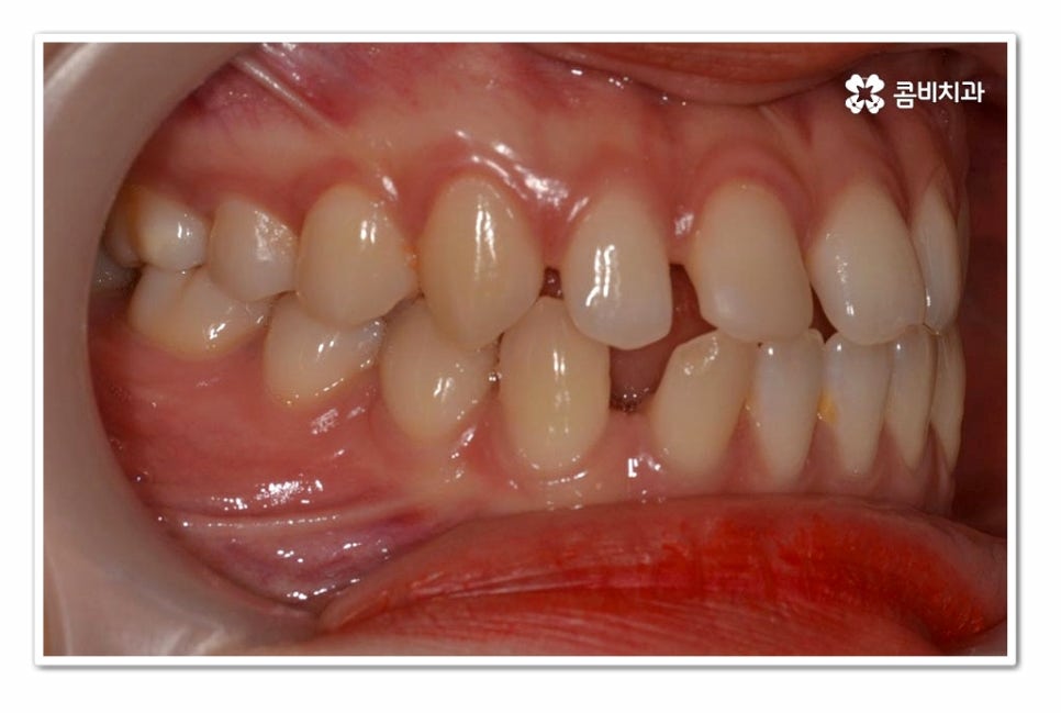앞니 벌어짐 똑똑하게 해결하려면 관련 이미지 2