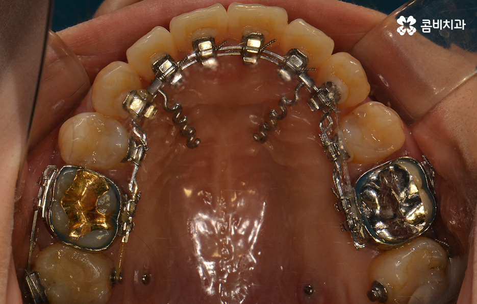 콤비교정 나에게 적합한지 판단하려면 관련 이미지 13