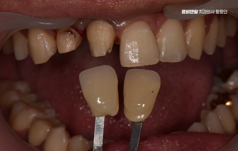 깨진 앞니 크라운 어떻게 해야 깔끔하게 해결될까 관련 이미지 7