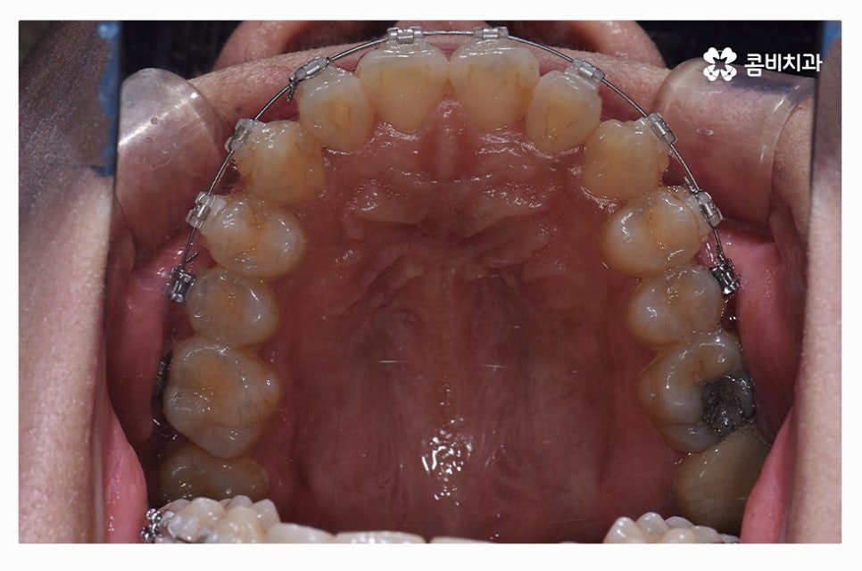 덧니교정 정교하게 따져보려면 관련 이미지 10