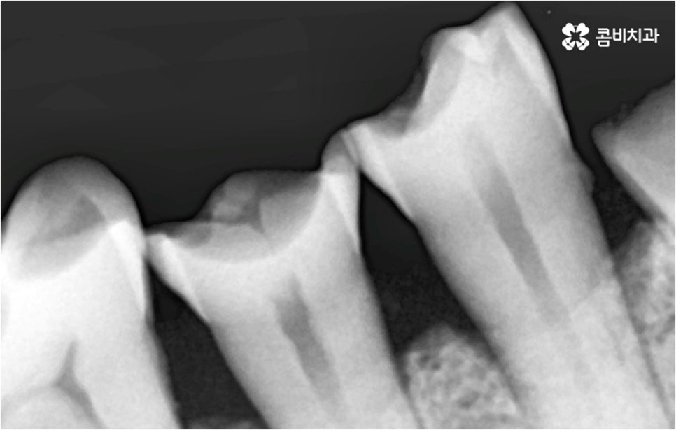 전악임플란트 고려할 사항들은 관련 이미지 4