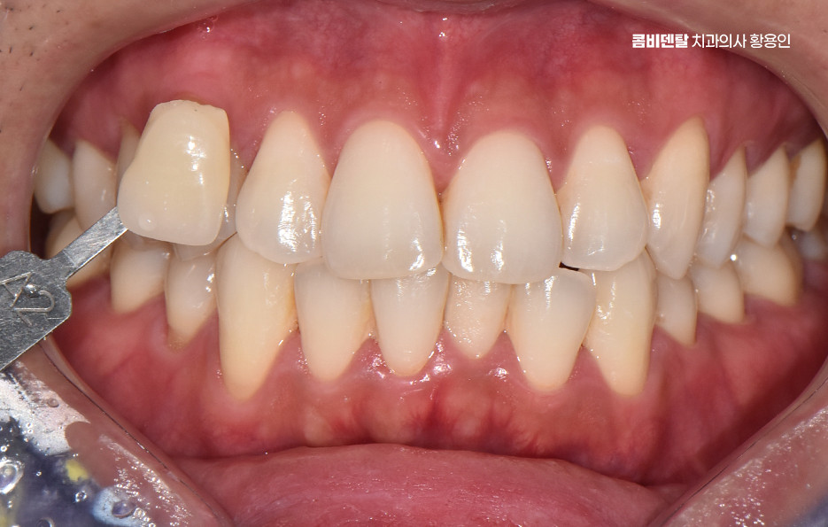 치과 치아미백 효과 어떤식으로 나타날까 관련 이미지 2