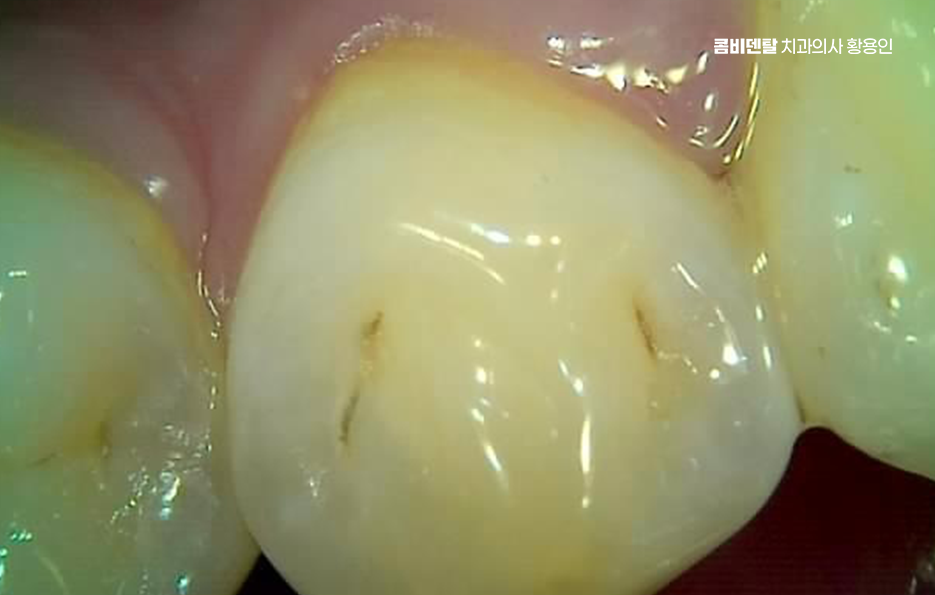 어금니 충치 단계 미리 알아차리려면 관련 이미지 10