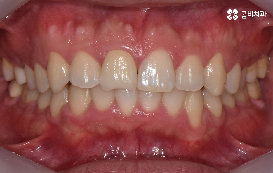 아랫니교정 이렇게만 파악하시면 됩니다 관련 이미지 12