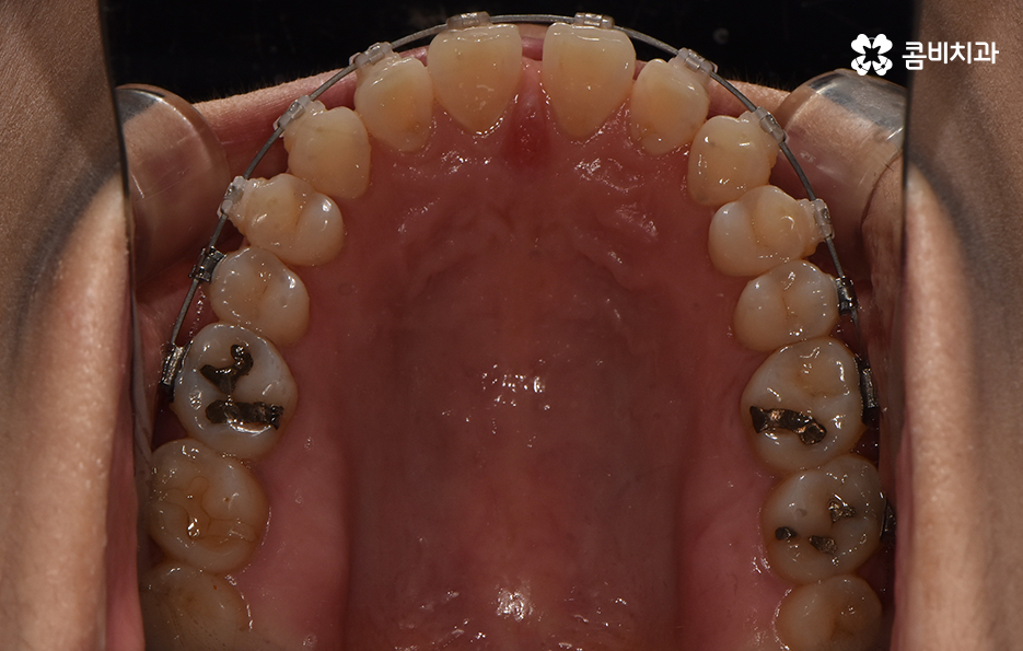 중년치아교정 이제라도 해도 될까요 관련 이미지 9