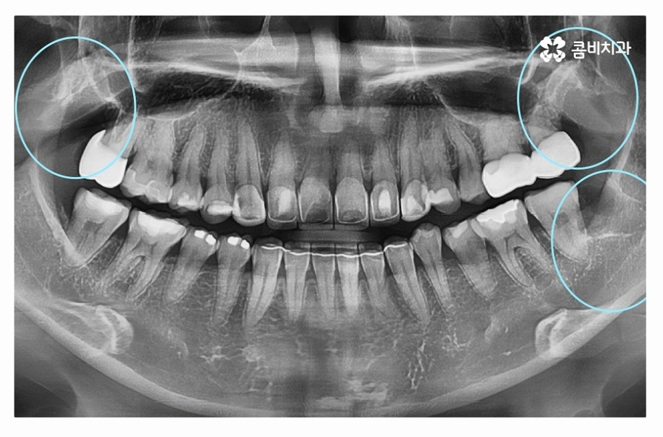 누운사랑니발치 언제 뽑을지 고민이라면 관련 이미지 10