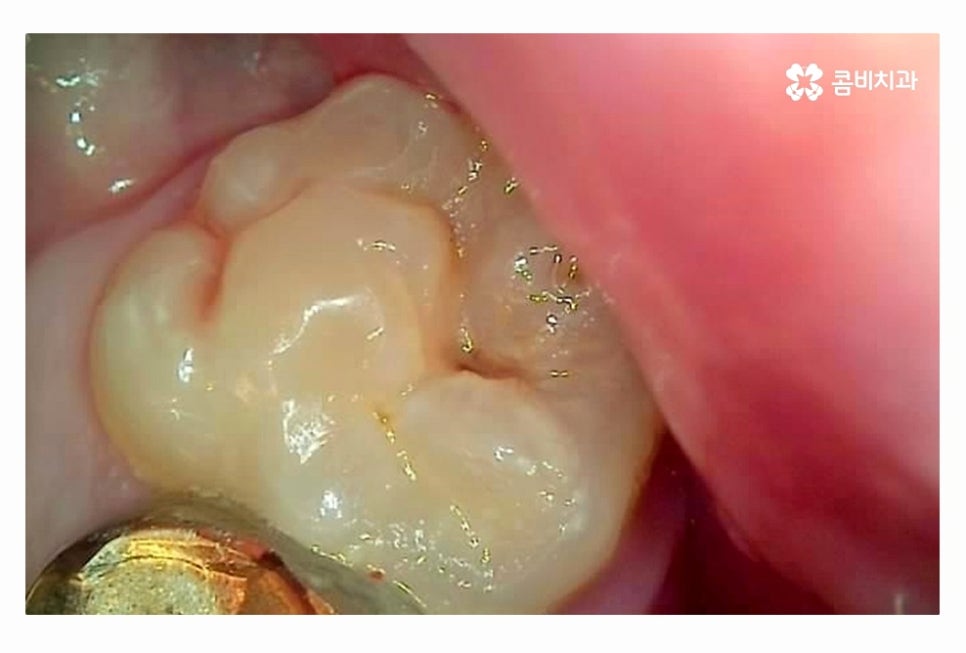 20대임플란트 갈수록 늘어나는 이유는 관련 이미지 5