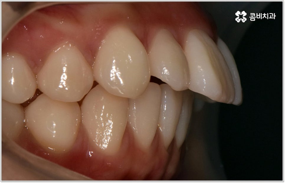 돌출입치아교정 언제가 적기인가요? 관련 이미지 11