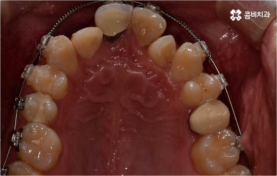 덧니교정 하고싶다면 관련 이미지 9