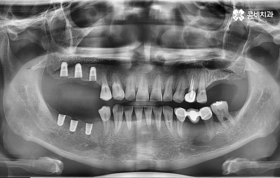 40대임플란트 치과에 이건 알고 가세요 관련 이미지 4