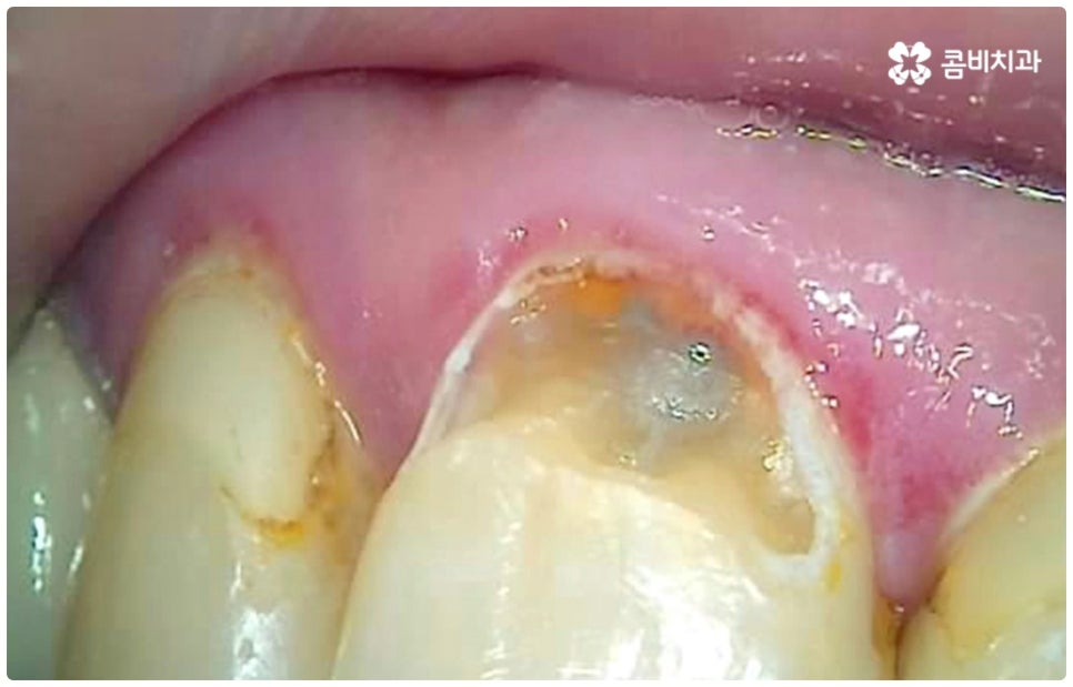 충치치료종류 알아볼까요? 관련 이미지 3