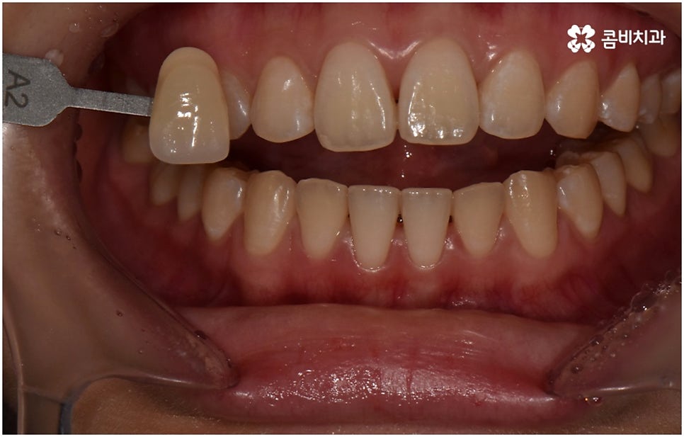 누런치아 하얗게 바꾸고 싶다면 관련 이미지 5