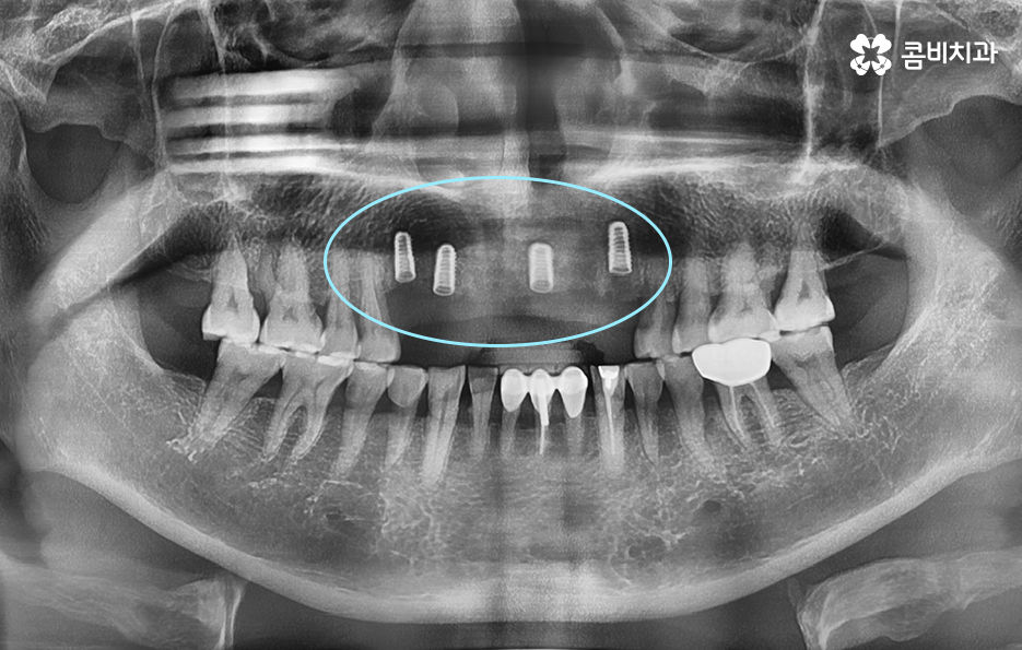 앞니임플란트 이런 조건들을 따져보세요 관련 이미지 3