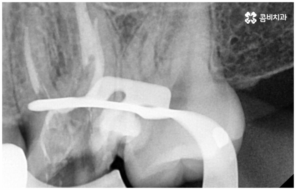 어금니신경치료 케이스마다 달라요 관련 이미지 6