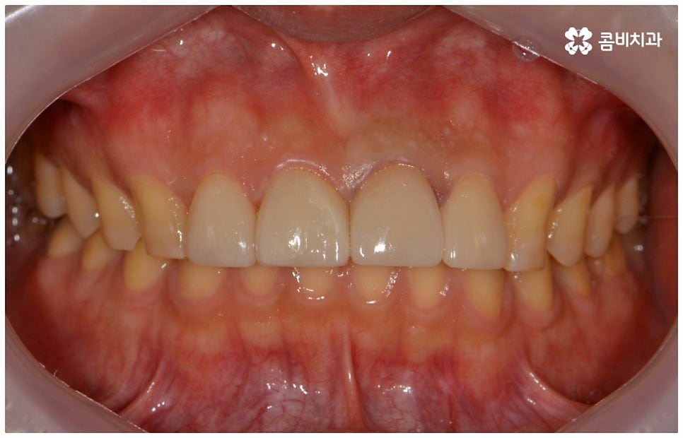 앞니충치치료 어떻게 이뤄지나요 관련 이미지 11