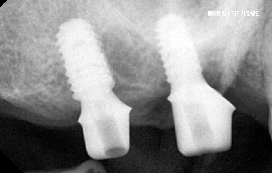 어금니 없으면 얼굴 발음에 어느정도나 안좋을까 관련 이미지 12