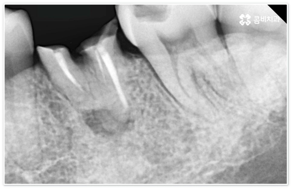 신경치료통증 무섭다고 미루면 관련 이미지 5