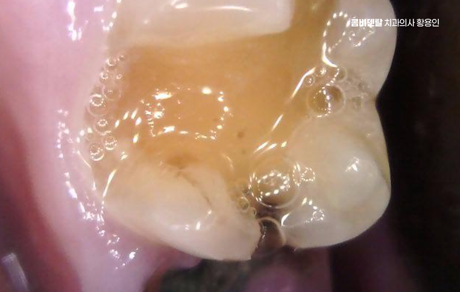 Be Careful Not to Delay Treatment for Cavities Between Your Teeth image 6