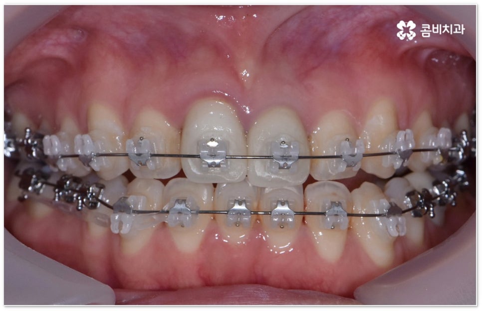치아교정장치 어떻게 고르나요 관련 이미지 6