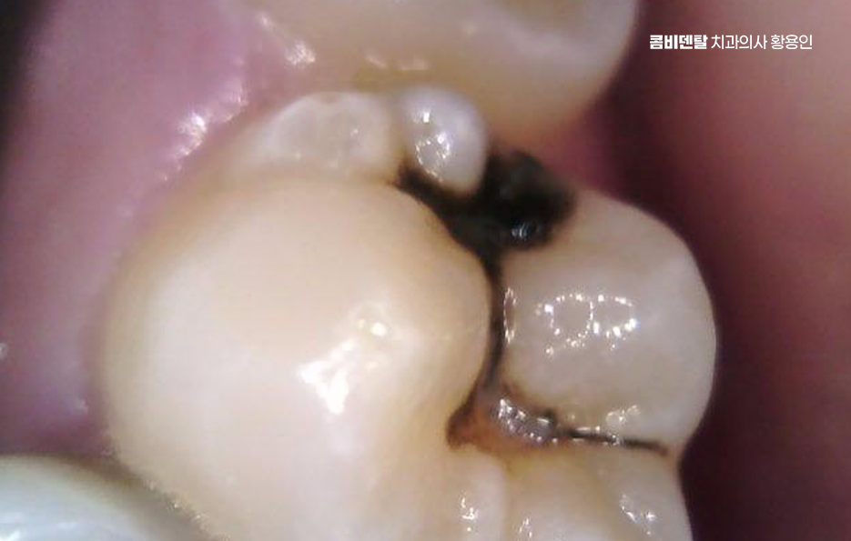 Be Careful Not to Delay Treatment for Cavities Between Your Teeth image 2