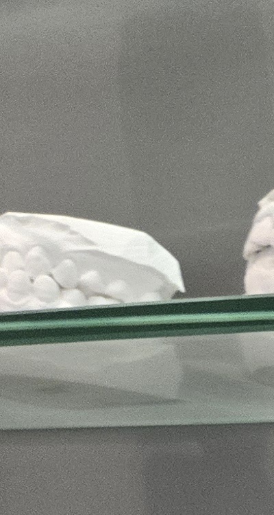 윗니 전체 임플란트 뭐부터 해야할까 관련 이미지 11