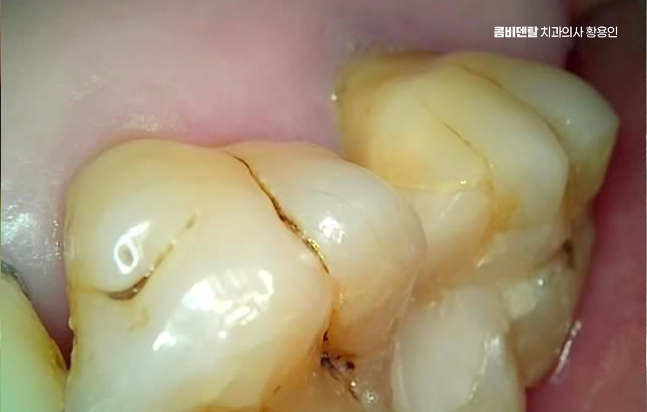 40대 임플란트 이대로 괜찮을까 관련 이미지 5