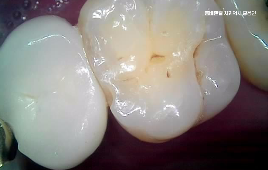 오래된 보철물 아말감 교체 어떠한 케이스일까 관련 이미지 4