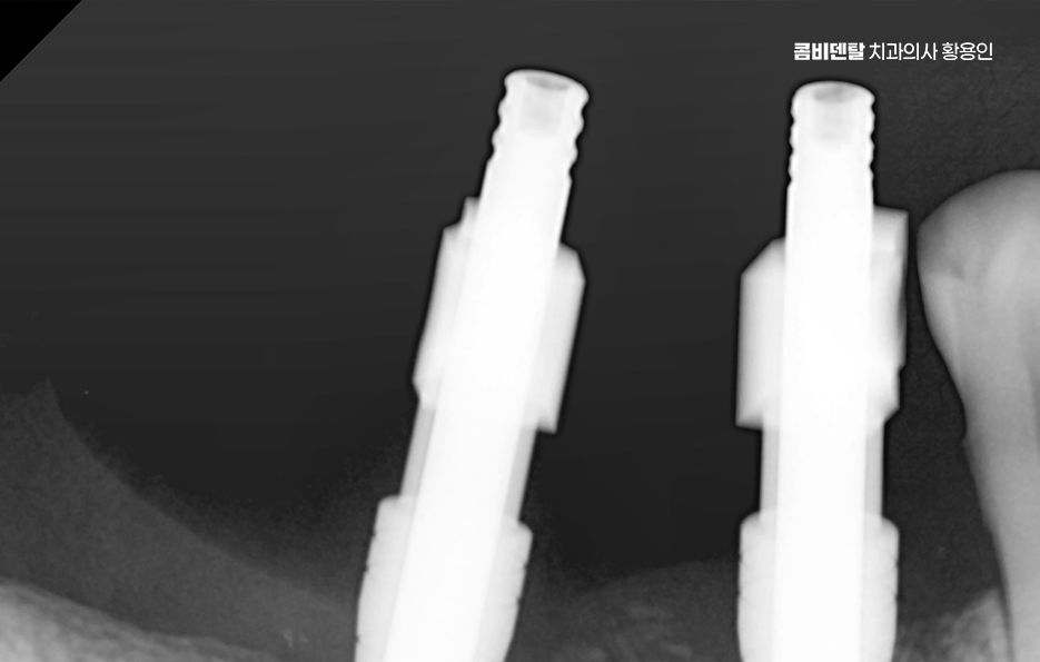 어금니 발치후 임플란트 안하면 어떻게 변하는걸까 관련 이미지 9
