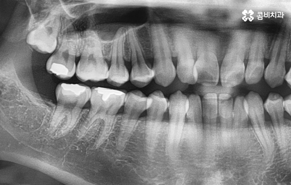 매복사랑니 냄새 방치하면 이런 문제도 생겨요 관련 이미지 5