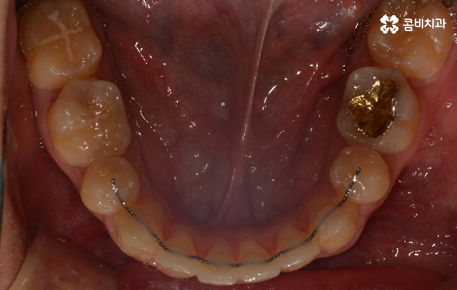 덧니교정 불편함이 느껴지지 않더라도 관련 이미지 15
