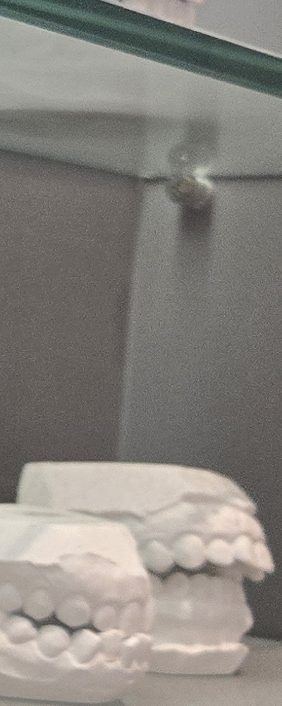 어르신 임플란트 지원 현명하게 활용하려면 관련 이미지 30