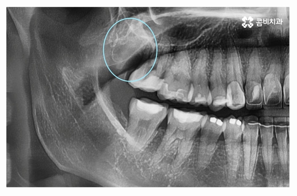 누운사랑니발치 언제 뽑을지 고민이라면 관련 이미지 8