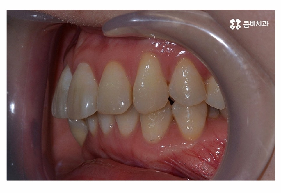 치아설측교정 가능한지 궁금하다면 관련 이미지 3