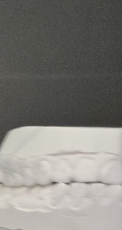 윗니 전체 임플란트 뭐부터 해야할까 관련 이미지 29