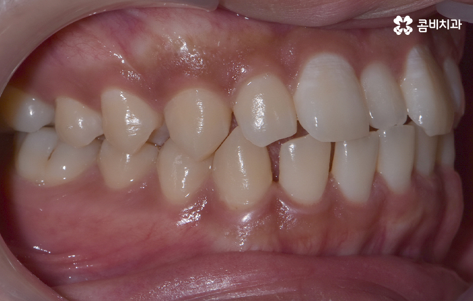 앞니만 교정 과잉치 뽑아서 해결했어요 관련 이미지 2