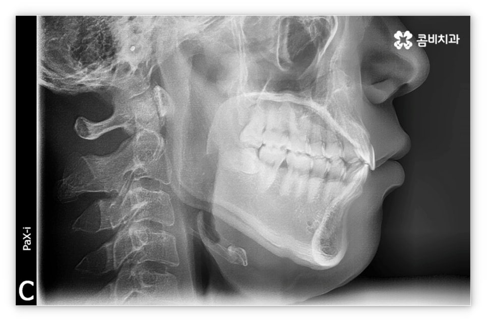앞니설측교정 망설여질때는 관련 이미지 2