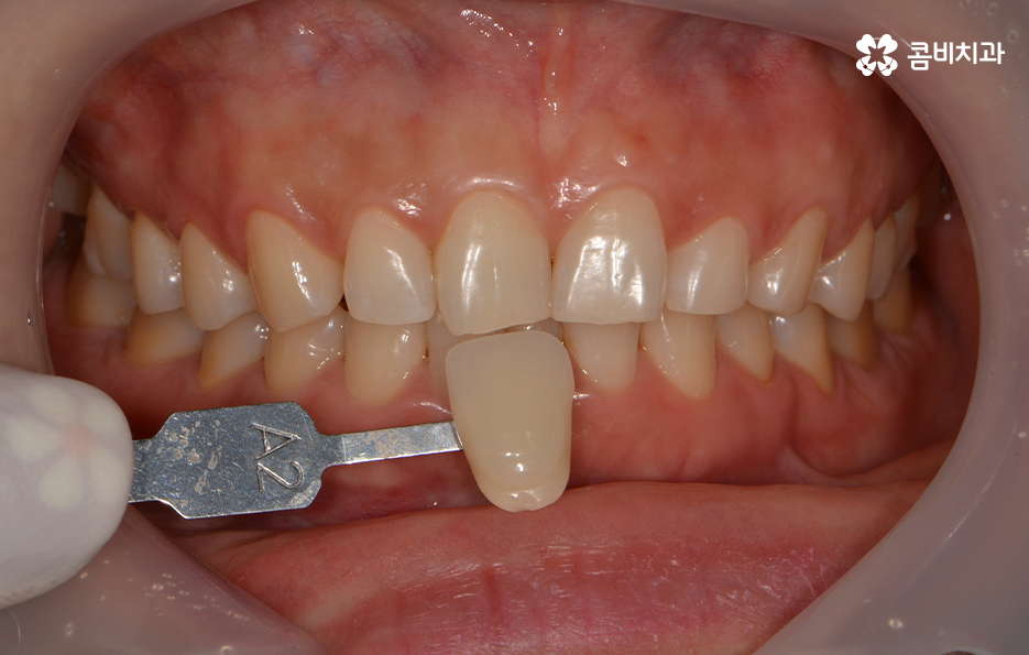 치과치아미백 어떻게 다른지 설명해드려요 관련 이미지 6